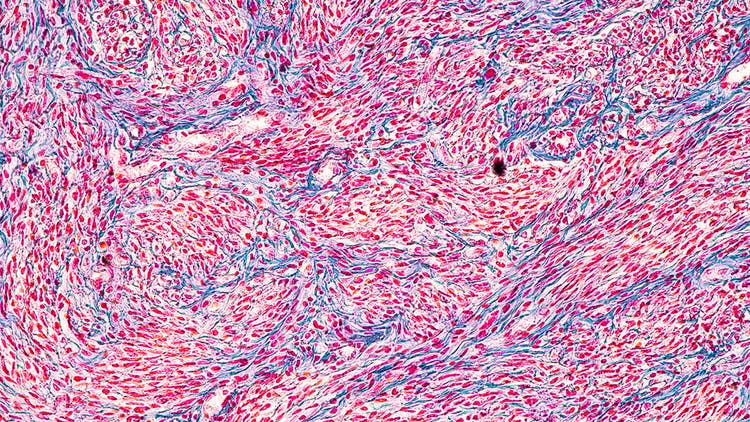 Image Analysis Headache