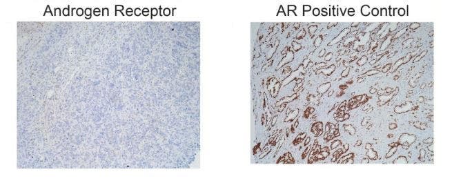 Androgen receptor immunohistochemistry labeling of PTEN KD/TE tumor and human prostate cancer tissue.