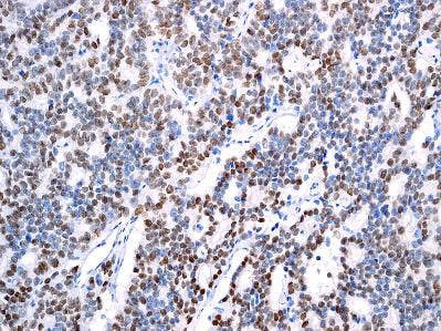 IHC staining of Androgen Receptor in human prostatic adenocarcinoma tissue using ab133273.
