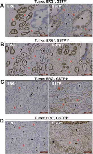 Immunohistochemistry of human prostate cancer samples showing ERG and GSTP1 staining using anti-ERG antibody ab92513