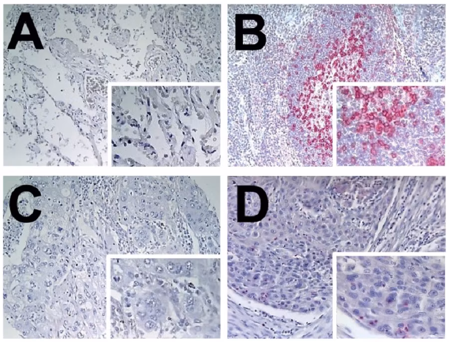 Immunohistochemical staining of PD1 protein expression in human tissues, including normal lung, tonsil, and tumor samples, demonstrating positive and negative staining patterns.