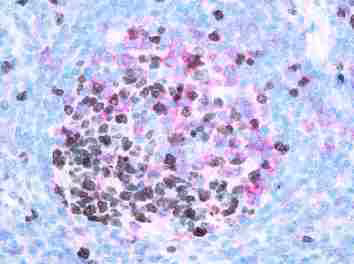 Immunohistochemistry staining of tonsil tissue showing Ki67 (brown) and PD1 (red) expression in formalin-fixed paraffin-embedded sections
