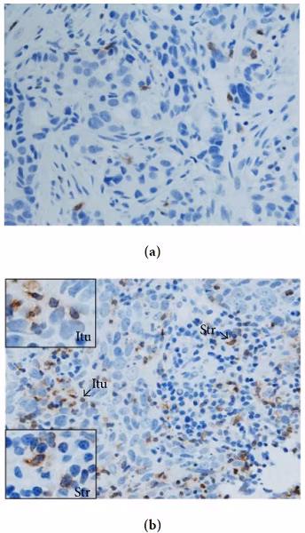 Immunohistochemical staining of human breast cancer tissue for PD-1 expression, showing varying levels of PD-1+ T cell infiltration in tumor and stromal regions.