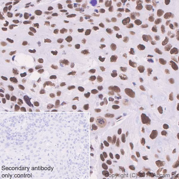 Immunohistochemical staining of BRG1 protein in human cervical carcinoma tissue.