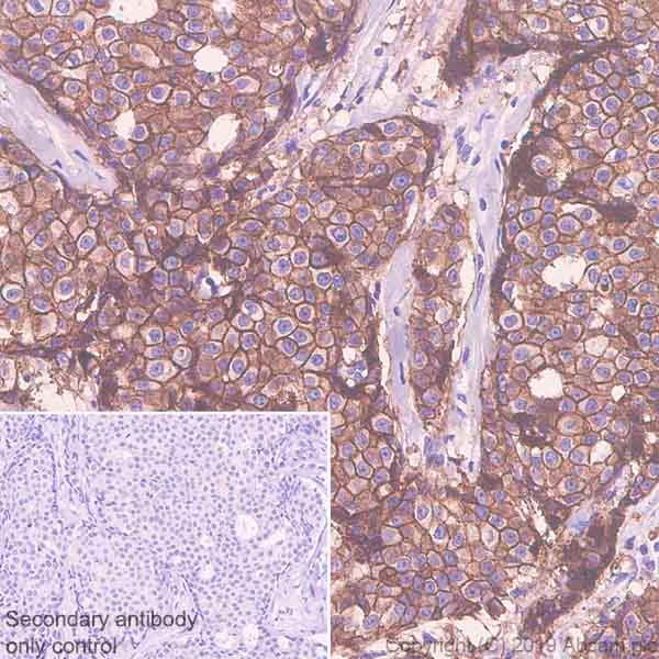 Immunohistochemical staining of ErbB2 in human breast carcinoma tissue.