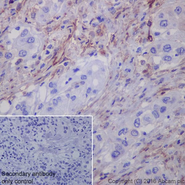 Immunohistochemical analysis of human pancreatic cancer tissue labeling Fibroblast activation protein, alpha.