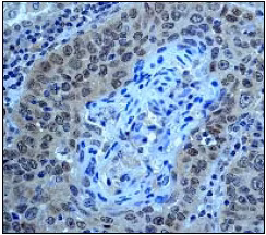Smad4 expression in human lung carcinoma tissue