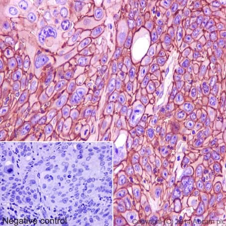 Immunohistochemical staining of human cervical carcinoma, showing tumor cells and negative control.