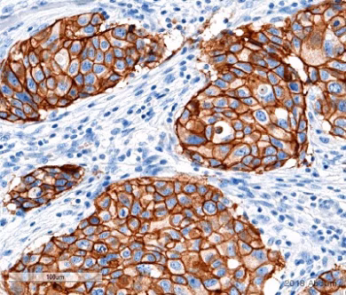 Immunohistochemical staining of ErbB2/HER2 in human breast invasive ductal carcinoma