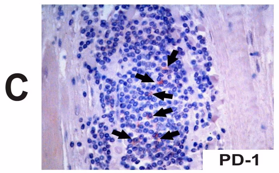 Immunohistochemistry image showing PD1 expression in heart tissue of a patient with chronic Chagas disease.