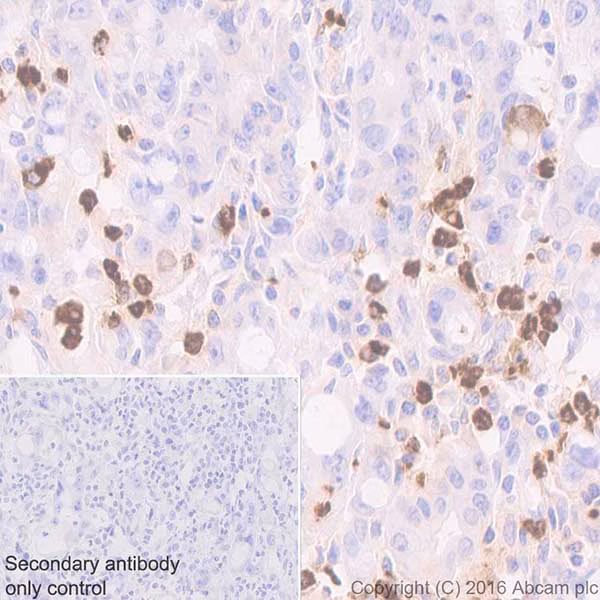 Immunohistochemical analysis of human stomach cancer tissue labeling Myeloperoxidase, showing cytoplasmic staining on neutrophils.