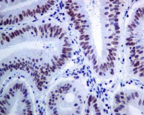 Immunohistochemistry staining of BRD4 in human colon carcinoma tissue using unpurified ab128874 at 1/100 dilution.