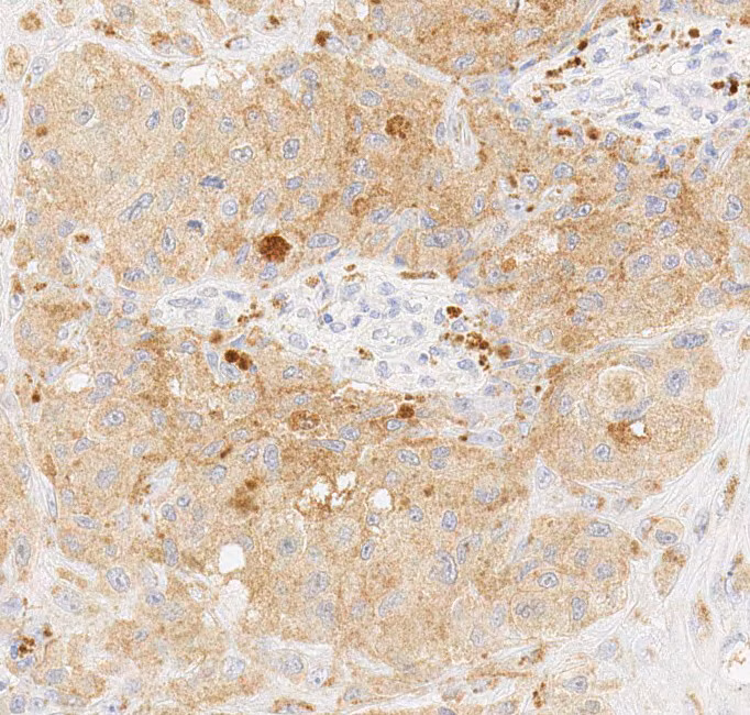 Immunohistochemical analysis of formalin-fixed paraffin-embedded human melanoma tissue (carrying mutant BRAF V600E) labelling BRAF (mutated V600E) with ab228461 at 1/100 dilution.