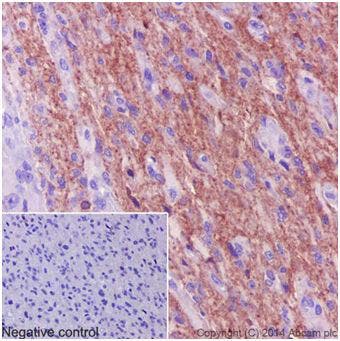 Immunohistochemical analysis of human astrocytoma tissue labeling Pan Trk, showing strong cytoplasmic staining in astrocytoma cells.