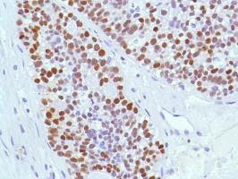 Immunohistochemical staining of estrogen receptor alpha in human ovarian adenocarcinoma tissue.
