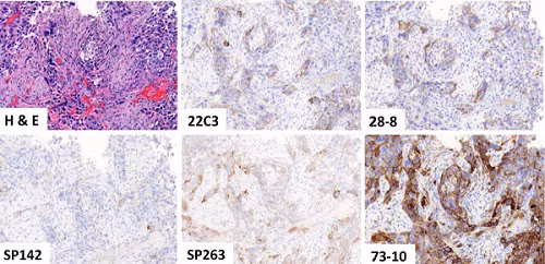 Lung cancer tissue stained with PD-L1 antibodies (ab228415, 73-10)
