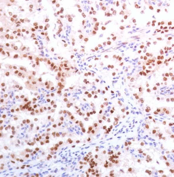 Immunohistochemistry of PAX8 in human renal cell carcinoma tissue using ab227707.