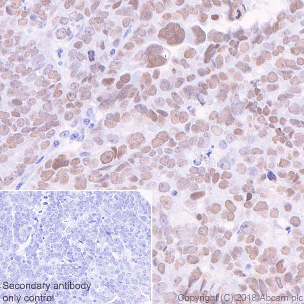 ab89901 staining wilms tumor protein in paraffin-embedded human ovarian serous adenocarcinoma tissue sections by Immunohistochemistry.