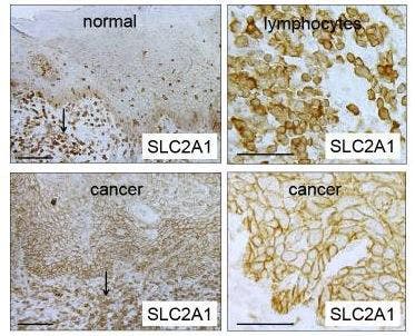 Immunohistochemical expression of Glut1 in normal tongue epithelium and tongue cancer.