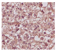Psme2 Antibody Epr14931 Bsa And Azide Free Ab250700  Immunohistochemistry Formalin Pfa Fixed Paraffin Embedded Sections Img139347
