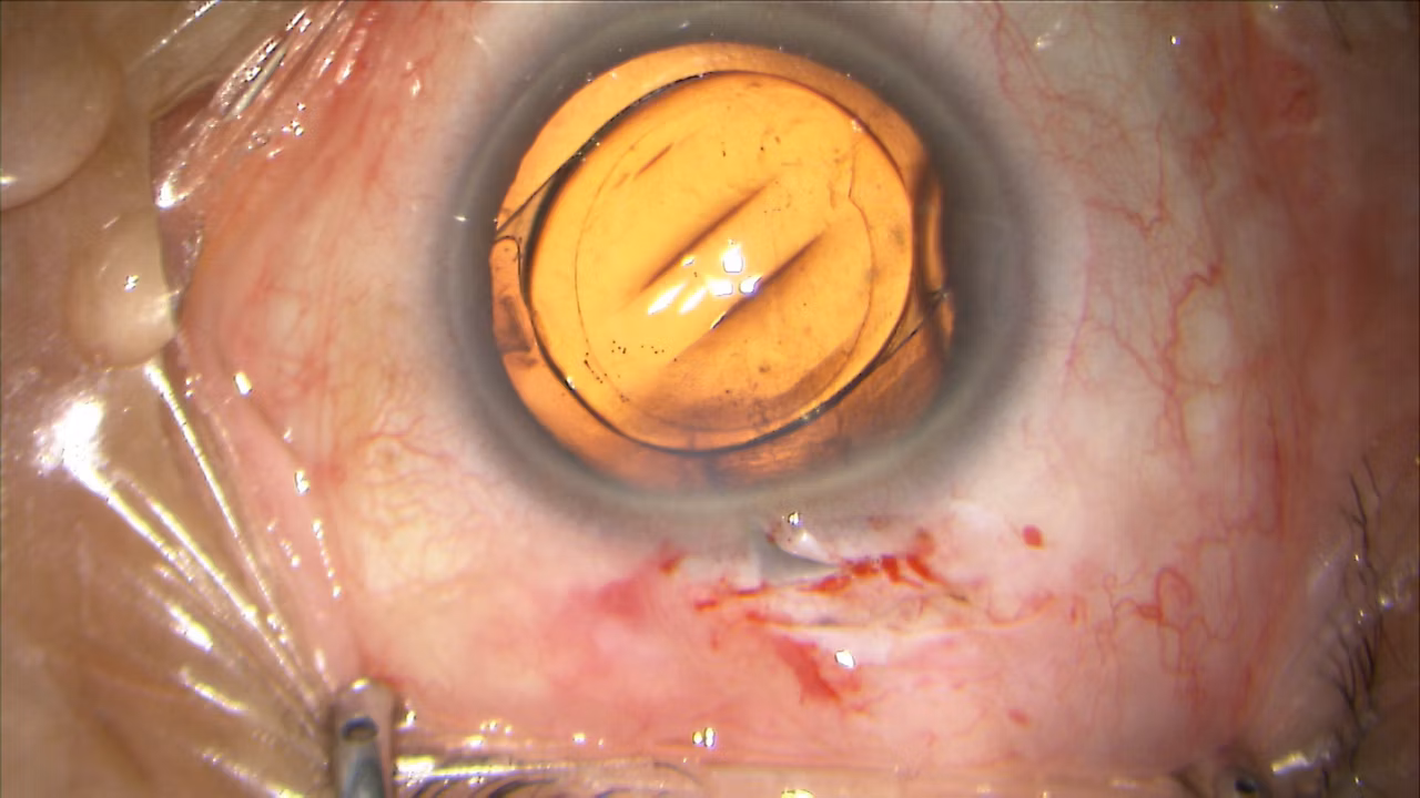 ToricEyePiece The Perfect Aid for Placement of Premium IOL's