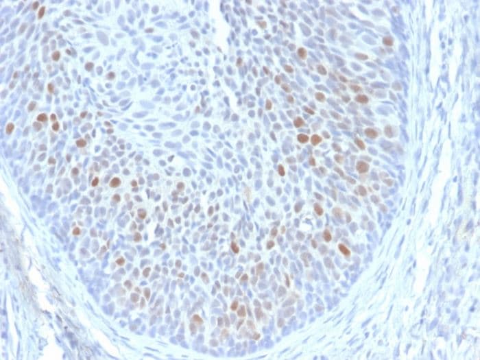 Hpv16 E1e4 Antibody Hpv16 E1 E4 Ab270738  Immunohistochemistry Formalin Pfa Fixed Paraffin Embedded Sections Img125097
