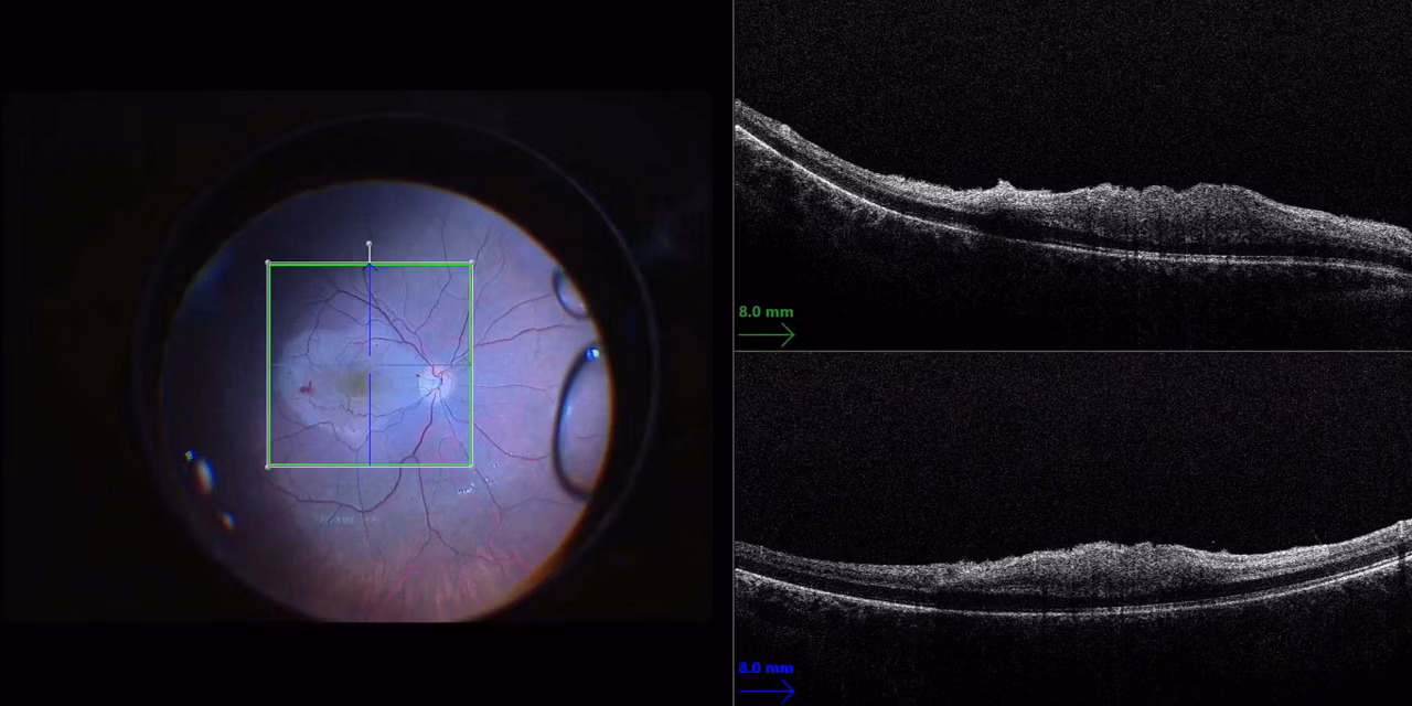 Benefits Retina Enfocus Kid21755729 1