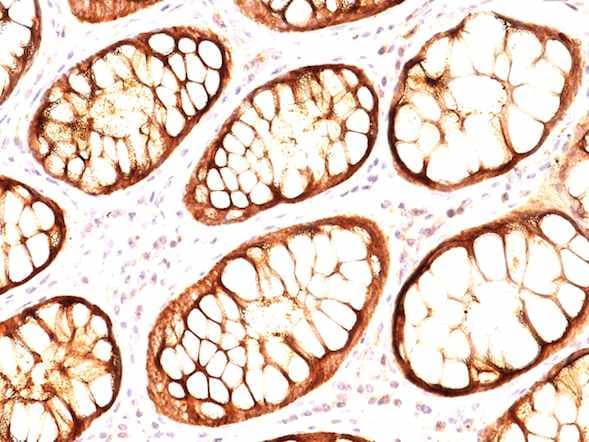 Muc1 Antibody Gp14 E29 Ab200543  Immunohistochemistry Formalin Pfa Fixed Paraffin Embedded Sections Img36130