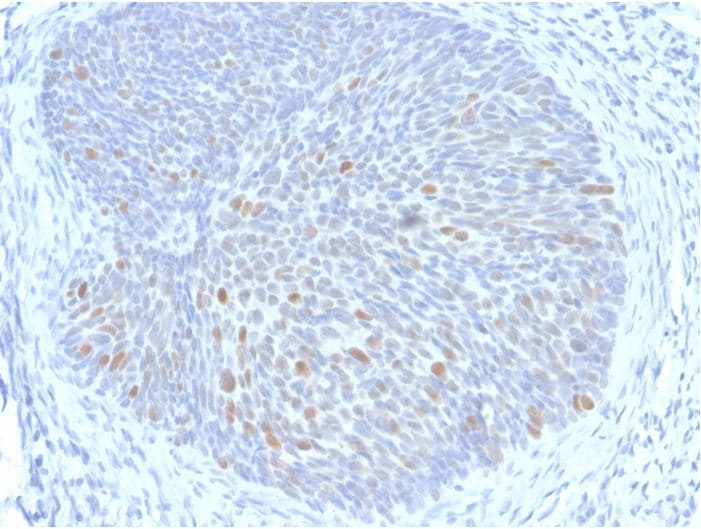 Hpv16 E1e4 Antibody Hpv16 E1 E4 Ab270738  Immunohistochemistry Formalin Pfa Fixed Paraffin Embedded Sections Img47392