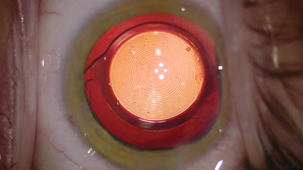 Proveo 8 Stable Red Reflex Surgery Kid21768827