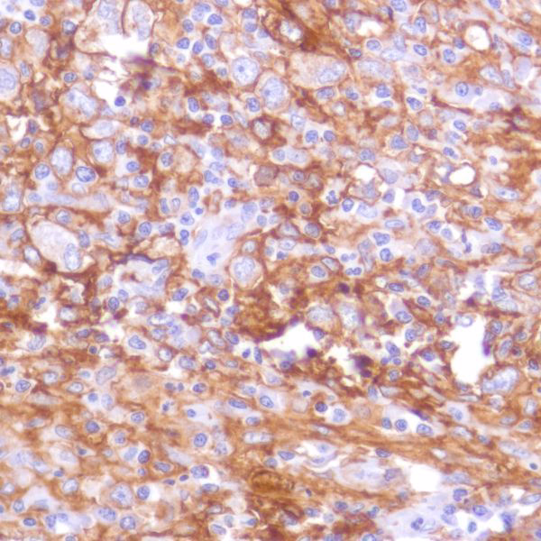 Pd L1 Antibody Sp142 C Terminal Ab228462  Immunohistochemistry Formalin Pfa Fixed Paraffin Embedded Sections Img120578