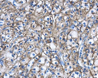 Carbonic Anhydrase 9 Ca9 Antibody Ab184006 Immunohistochemistry Formalin Pfa Fixed Paraffin Embedded Sections Img450389