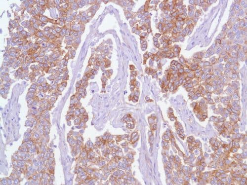 Egfr Antibody Sp84 Bsa And Azide Free Ab238803  Immunohistochemistry Formalin Pfa Fixed Paraffin Embedded Sections Img94363