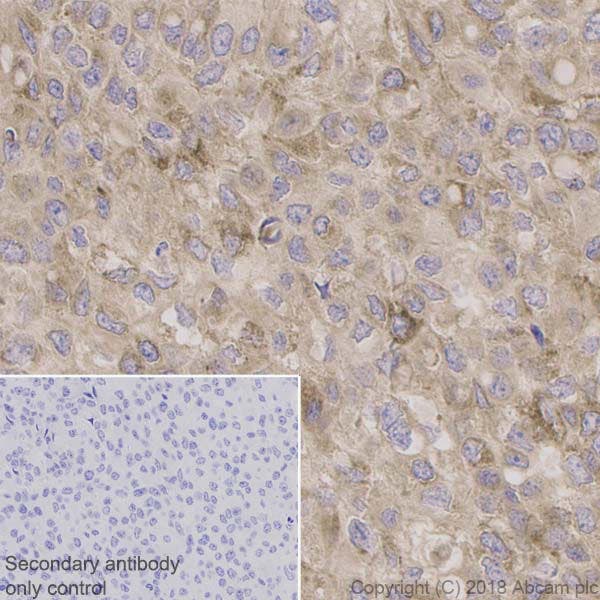 Immunohistochemistry analysis of human bladder cancer tissue showing BDNF expression.